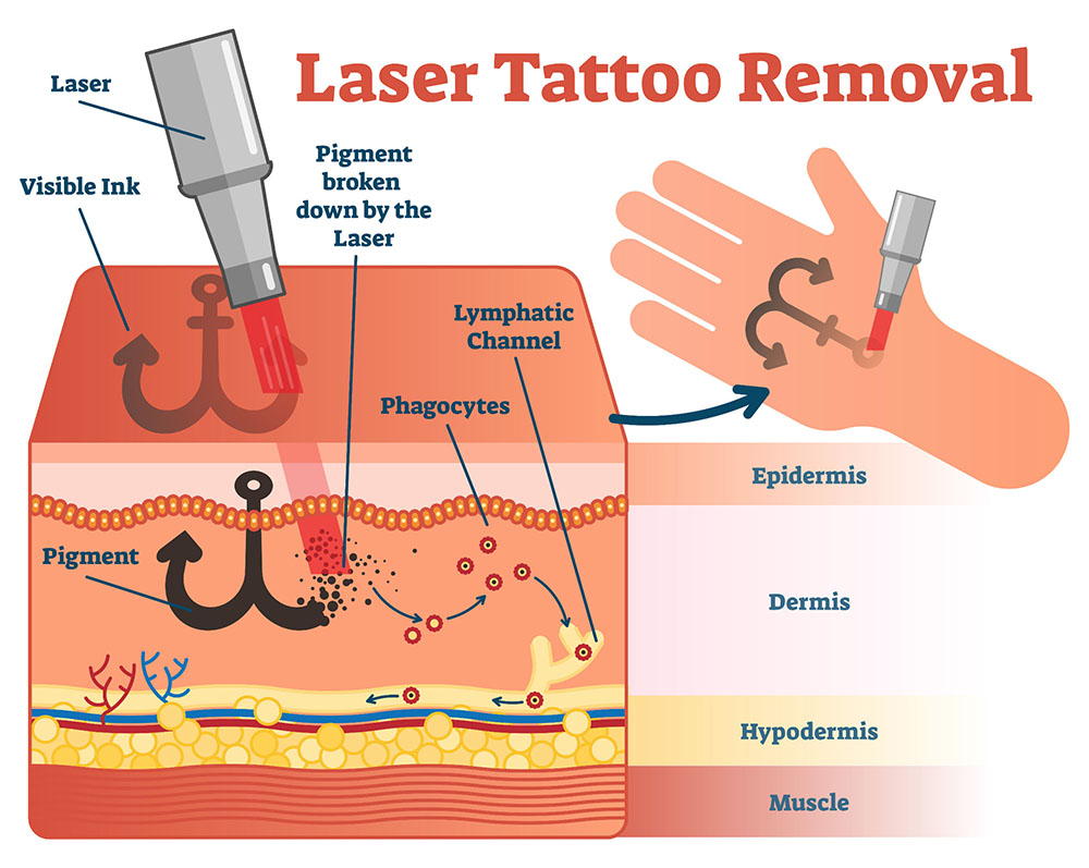 How to remove permanent tattoo without laser - Quora